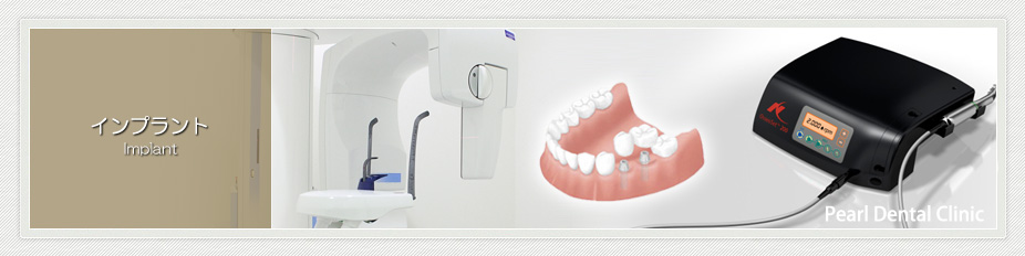 インプラント