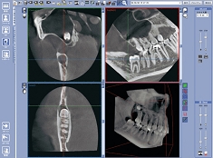 歯科用ＣＴの有用性